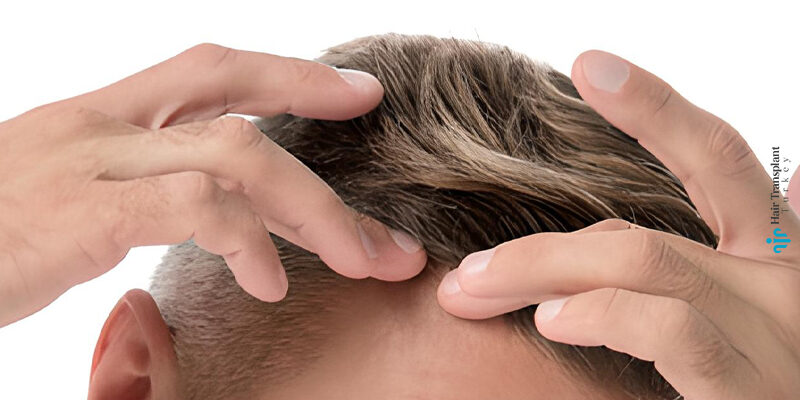 Is Hair Shedding Normal After Hair Transplantation?